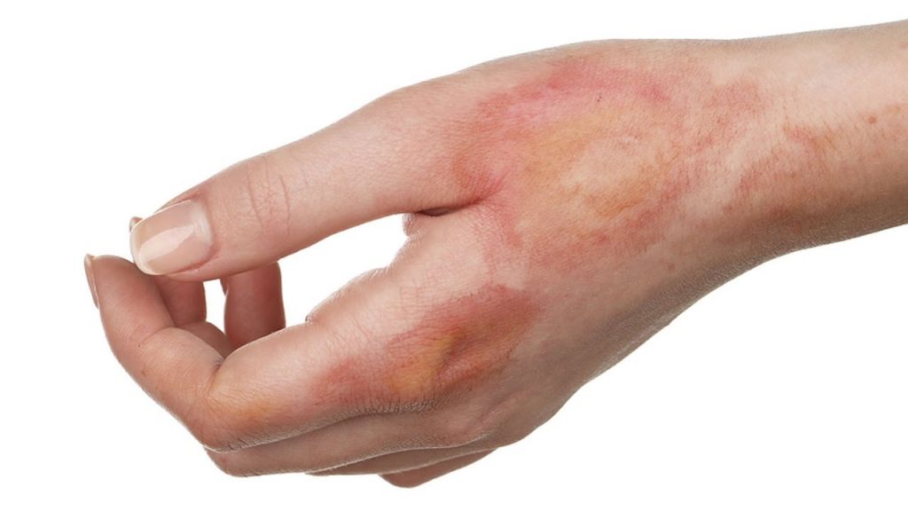 Mẹo chữa bỏng tại nhà