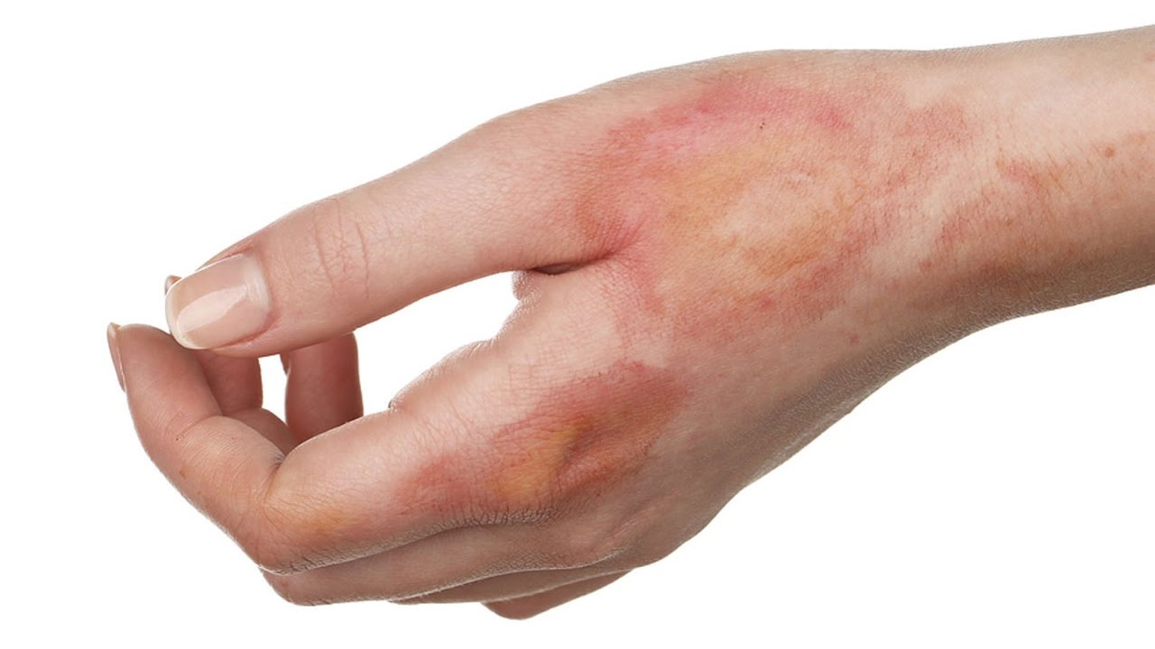 Mẹo chữa bỏng tại nhà