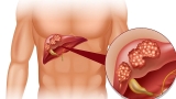 Những điều cần biết về Viêm gan B